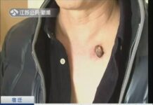สุดช็อค! ชายจีนแกะไฝออกตอนอาบน้ำ สุดท้ายกลายเป็นมะเร็ง